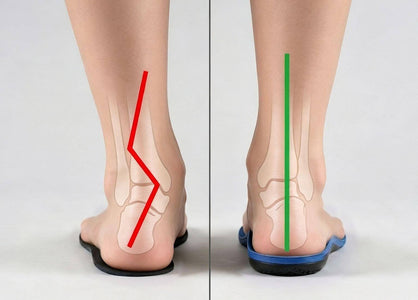 Orthotics vs Insoles: Key Differences, Benefits & Best Choice